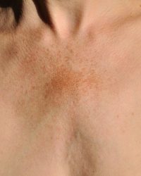 Huidindactie Hyperpigmentatie - Beautique Salon - huidverbetering - huidverbeterende behandelingen