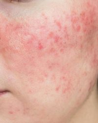 Huidindactie Rosacea - Beautique Salon - huidverbetering - huidverbeterende behandelingen